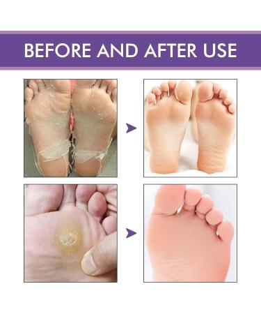 CAOQAO Foot Peel 3 Pack Exfoliator Peel Off Dead Skin Remover 53ML Nail Care Products (Purple One Size) 40 g (Pack of 1) Purple - Buy Online on GoSupps.com