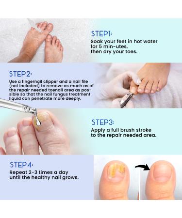 Extra Strength Toenail Treatment - Nail Renewal Repair Solution for Thick Broken & Discolored Nails (1oz) | International Shipping - Buy Online on GoSupps.com