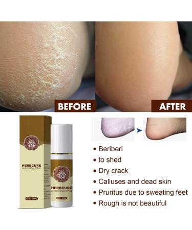 2pc Athlete's Foot & Peeling Spray Set - 60ml | Foot Odor Eliminator for Men & Women - Buy Online on GoSupps.com