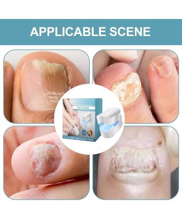 Rrlihjgu Fingernail Care Device | Nail Treatments Device for Fingernails & Toenails Fingernails Treatments Versatile Professional Nail Repair Device for Normal & Abnormal Nails - Buy Online on GoSupps.com