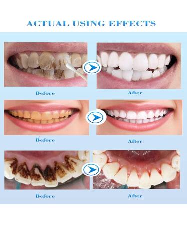 Whiteout Instant Teeth Whitening Paint - Instant Teeth Whitening (2 Pack) | Brighten Your Smile Quickly! - Buy Online on GoSupps.com