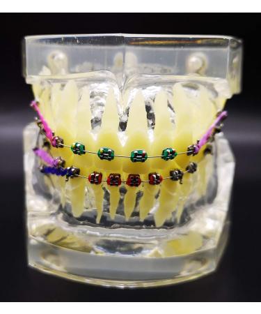 Dental Typodont Orthodontic Teeth Model with Metal Braces & Ligature Ties - Buy Online on GoSupps.com