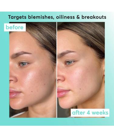 Super Facialist Breakout Buster Serum - Clear Skin Solutions Spot Treatment for Acne with 10% Niacinamide Tea Tree Oil & Prebiotics Vegan Friendly 30ml - Buy Online on GoSupps.com