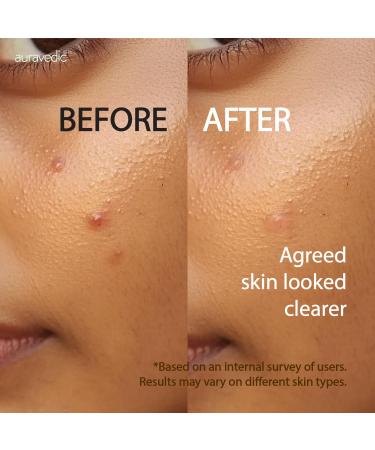 Auravedic Acne Face Wash with 2% Salicylic Acid Neem & Tea Tree | Foaming Cleanser for Oily & Acne Prone Skin | Oil Control Gentle Daily Cleanser for Men & Women | 4.06 Fl Oz (120ml) - Buy Online on GoSupps.com