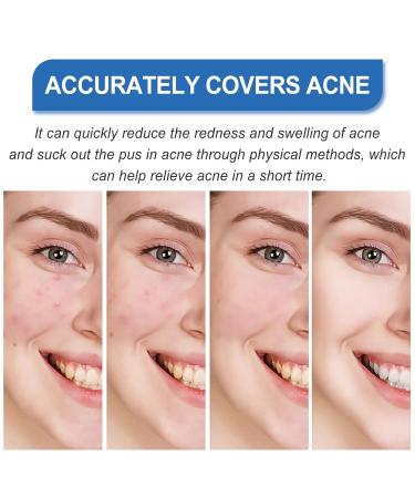 Buy Facial Acne Patches - Hydrocolloid Treatment with Tea Tree Oil & Salicylic Acid | 216 Tablets for Pimples & Blemishes - Buy Online on GoSupps.com