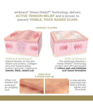 X-Large Silicone Scar Sheets - 6.3 Inch, FDA-Cleared, 30 Day Supply | Active Scar Defense for New Scars - Buy Online on GoSupps.com