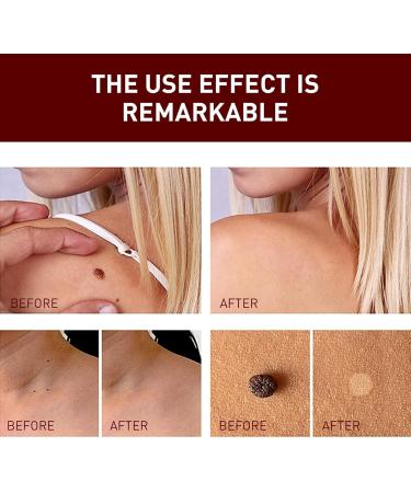 Anti Wart - Anti Wart Pen - Pen To Remove Mole - Anti Skin Tag Pen - Pen To Remove Skin Tags Remove Skin Tags - Buy Online on GoSupps.com
