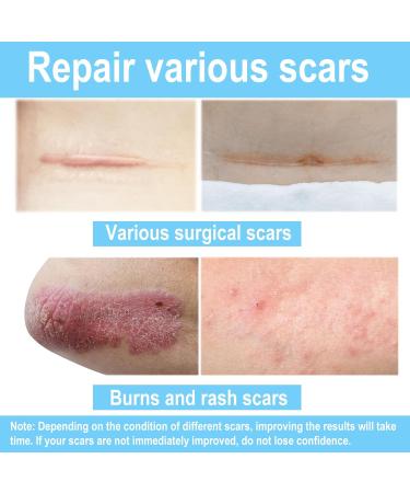 Silicone Scar Sheets 1.6 x 120 - Effective Scar Treatment Tape for Keloids Tummy Tuck & Surgical Scars - Premium Silicone Scar Strips - Buy Online on GoSupps.com