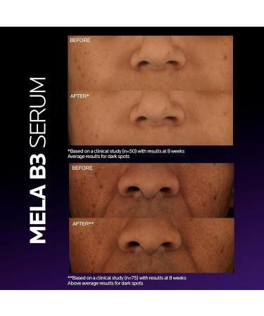 La Roche-Posay Mela B3 Serum  Dark Spot Corrector With Anti-Aging Melasyl + 10% Niacinamide  Discoloration Correcting Serum for Sun Spots  Age Spots & Post-Acne Marks  Long-Lasting Results  30ML - Buy Online on GoSupps.com