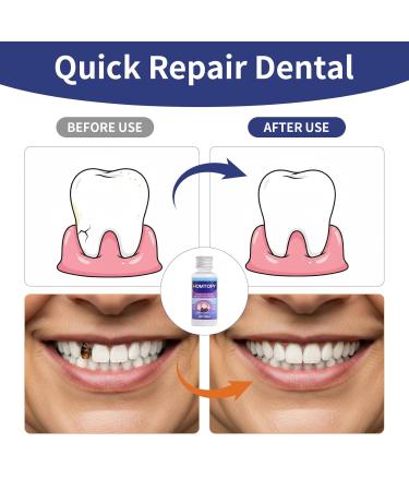DIY Temporary Tooth Repair Kit - Heat Fit Beads for Missing & Broken Teeth 4 Tools Included Natural Comfortable Men & Women - Regain Confident Smile - Buy Online on GoSupps.com