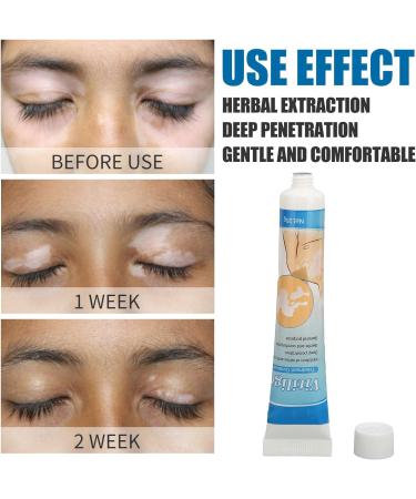 Vitiligo Repair Cream - Herbal Extract Treatment Ointment for Skin Pigmentation 0.7oz - Buy Online on GoSupps.com