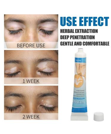 LIULDASHUN Vitiligo Cream - Natural Herbal Extract Treatment Ointment for Skin Pigmentation - 0.7oz - Buy Online on GoSupps.com