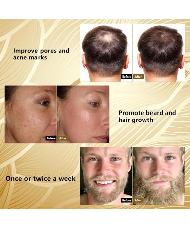 Derma Roller Beard Roller 540 Titanium Micro Needle for Beard Growth & Skin Care - Travel Case Included - Buy Online on GoSupps.com