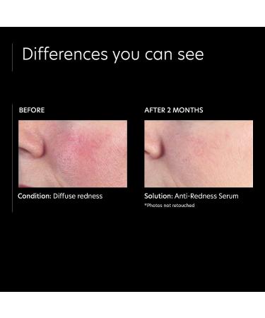 PCA SKIN Anti Redness Remover Face Serum - Calming Oil-Free Treatment for Irritation & Skin Tone - 1 fl oz - Buy Online on GoSupps.com