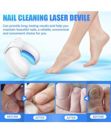 Buy Nail Fungus Laser Treatment Device - Rechargeable & Portable Cold Laser Therapy for Fingers & Toenails - Buy Online on GoSupps.com