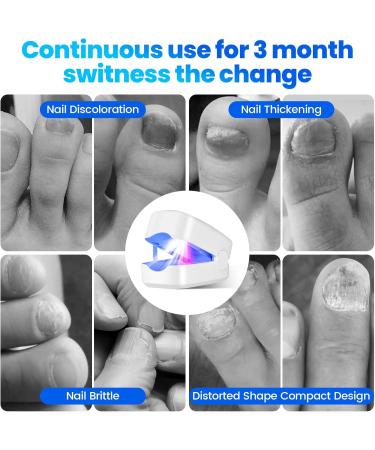 Neulriscn Anti Fungal Nail Treatment Device Nail Fungus Laser Treatment Device for Toenails & Fingernails 7 Mins Per Day 910nm Infrared Light 460nm Blue Light for Nails Onychomycosis Use at Home - Buy Online on GoSupps.com