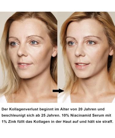 Buy Niacinamide 10% + Zinc 1% Serum - Brightening & Pore Tightening Facial Care for Men & Women - Anti-Acne Solution - International Shipping - Buy Online on GoSupps.com