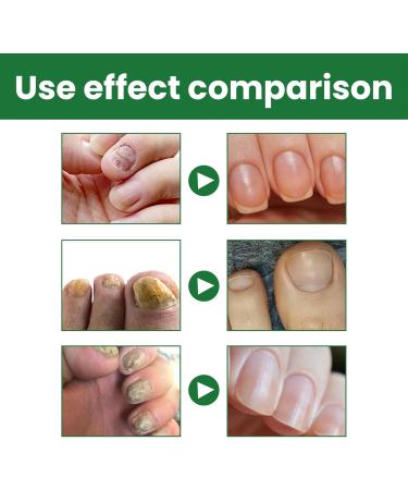 Fungal Nail Serum for Toenails Extra Strong Natural Anti Fungal Nail Serum Severe Fungal Nail Serum for Toenails and Fingernails Anti fungus Nail Improve and Strengthen - Buy Online on GoSupps.com