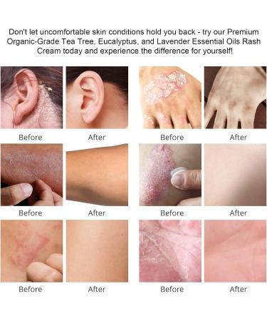 Heat Rash Cream  Eczema  Hand Foot Treat  Tinea Versicolor  Itchy Feet  Butt  Anal Itch  Psoriasis  Scalp Dandruff  Bee Sting  Bites  Boil Cyst  Armpit  Adults Kids  Hidradenitis Suppurativa Treat - Buy Online on GoSupps.com