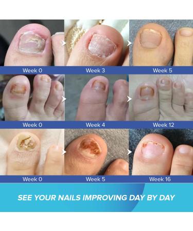 Extra Strength Toenail Fungus Treatment - 1% Tolnaftate for Discolored Nails & Athlete's Foot (30ml) - Fast-Acting OTC Formula - Buy Online on GoSupps.com