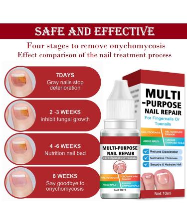 Fungal Nail Treatment Solution - Extra Strong Repair for Toenails & Fingernails - Safe & Effective - 2pcs x 1.00 ml - Buy Online on GoSupps.com