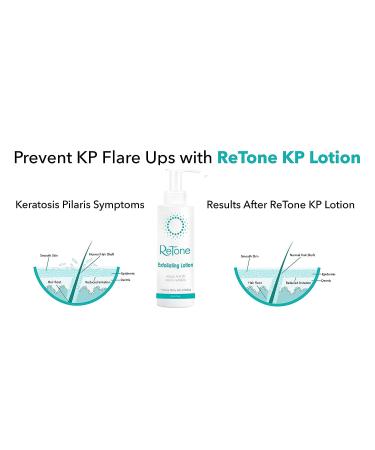 ReTone Keratosis Pilaris Exfoliating Body Lotion | KP Treatment for Body Acne | Hemp Oil + Urea + Salicylic Acid + Lactic Acid | Gentle Exfoliation for Smooth Skin - Buy Online on GoSupps.com