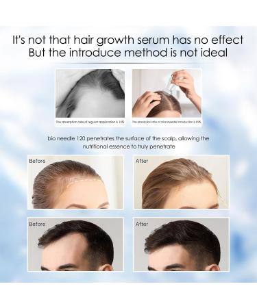 Derma Stamp with 120 Adjustable 2.0mm Titanium Pins Derma Stamp for Hair Beard Growth Microneedling Pen Micro Needle for Face Skin Rejuvenation Derma Roller Skin Care Beauty Tool for Women Men 120-A - Buy Online on GoSupps.com