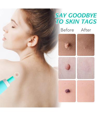 2 in 1 Skin Tag Remover Pen Kit - Painless Micro Skin Tags & Moles Removal for All Body Parts - Buy Online on GoSupps.com