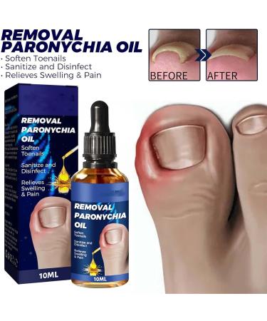 BaBound German Toenail Care Paronychia Oil German Toenailcare Removal Paronychia Oil Toenailcare Oil For Paronychia Removal German Toenailplus Anti Paronychia Relief Oil 1PCS - Buy Online on GoSupps.com