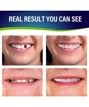 2 PCS Dentures Teeth for Women and Men - Comfortable Dental Veneers for Upper and Lower Jaw - Natural Temporary Fix for Confident Smile - Buy Online on GoSupps.com