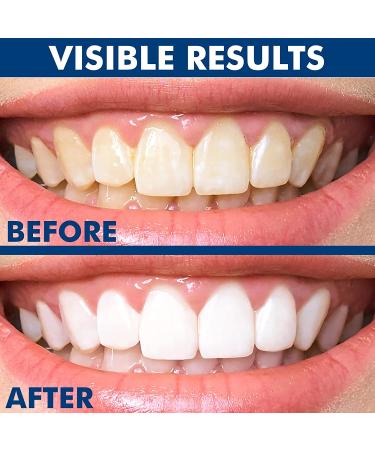 SmileWhite Teeth Whitening Pen (4 Pens) - Kit with Gel for Effective, Painless Results | Non-Sensitive, Travel-Friendly | Natural Mint Flavor - Buy Online on GoSupps.com