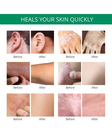 Hermon Psoriasis Eczema Relief Cream: Maximum Strength for Psoriasis Eczema - Relieve Symptom of Resistant Effective for Seborrheic Dermatitis Folliculitis 100m 3.4 Fl Oz (Pack of 1) - Buy Online on GoSupps.com