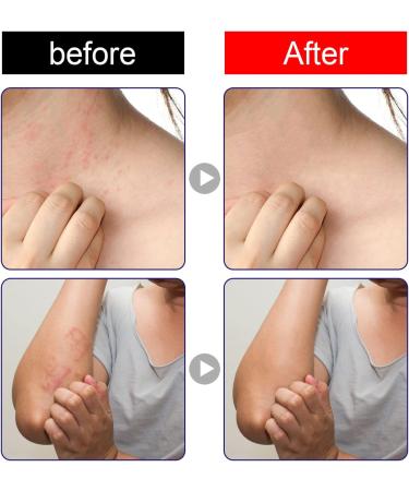 30g Herba Violae Natural Plant Anti-Itch Cream for Mosquito Bites & Skin Itch Relief - Buy Online on GoSupps.com