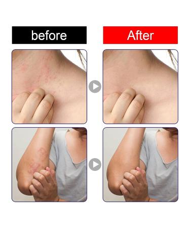 Gentle 30g Itch Relief Cream with Violets Cnidium Extract - Anti-Itch Ointment for Sensitive Dry Skin - Buy Online on GoSupps.com