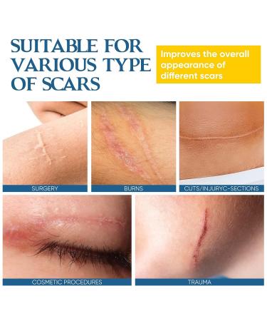 Advanced Silicone Scar Gel for Keloid Bump Removal & Treatment - Nose, Ear, Belly Piercings, Stretch Marks, Burn, Surgical, C-Section, Old & New Scars - Buy Online on GoSupps.com