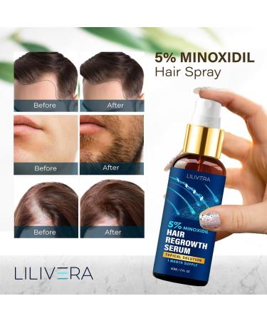 5% Minoxidil Hair Growth Serum for Men & Women - 60mL Spray for Hair & Beard Regrowth - Effective Hair Loss Treatment - 1 Month Supply - Buy Online on GoSupps.com