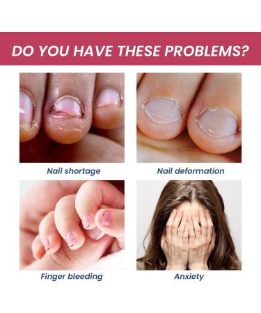 Anti Nail Biting Polish - Stop Biting Nails - Nail Biting Prevention - Stop Nail Repair Clear Varnish - Discourages Nail Biting and Thumb Sucking For Children and Adults - Buy Online on GoSupps.com