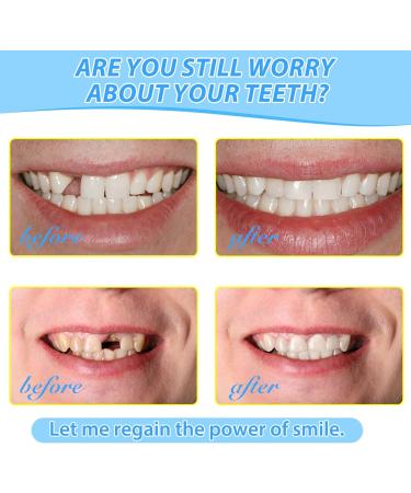 Temporary Tooth Filling Tooth Filling Repair Kit False Teeth for Temporary Tooth Filler Chipped Tooth Repair Kit for Broken & Missing Teeth Replacement (Tooth Repair Kit) - Buy Online on GoSupps.com