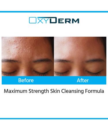 Acne Face Wash Treatment with 5% Benzoyl Peroxide - Clinically Proven Cleanser for Cystic Breakouts Oily Skin Blackheads & Pimples - Buy Online on GoSupps.com
