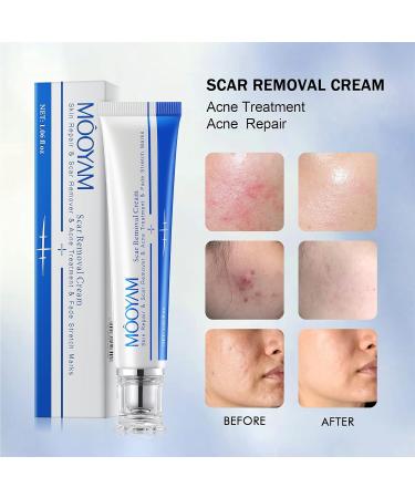 Scar Removal Cream - Rapid Repair for Acne, Surgery, Injury & Burns - 30g - Buy Online on GoSupps.com