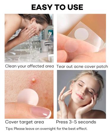 Acne Patch 140 Count Hydrocolloid Absorbing Cover Patch with Tea Tree & Calendula Oil - 4 Sizes Acne Dots for Face - 1 Pack - Buy Online on GoSupps.com
