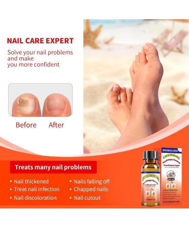 Extra Strength Toenail Fungus Treatment - 30ML Nail Solution with Soft Brush - Transform Your Nails & Boost Confidence - Buy Online on GoSupps.com