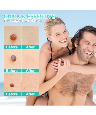 New Version Auto Skin Tag Remover Kit 2-Set Painless Skin Tag Removal Kit Tools for (1-9mm) Skin Tags (includes 100 Removal Bands & 36 Repair Patches & 20 Pcs Cleansing Wipes) Blue Green 2pcs Kit - Buy Online on GoSupps.com