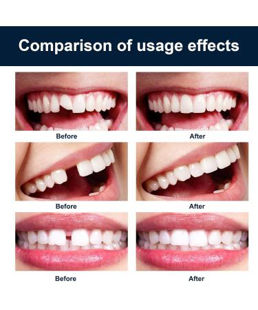 Temporary Tooth Repair Temporary Tooth Replacement Kit Temporary Moldable Tooth Moldable Teeth Granules Tooth Temporary To - Buy Online on GoSupps.com