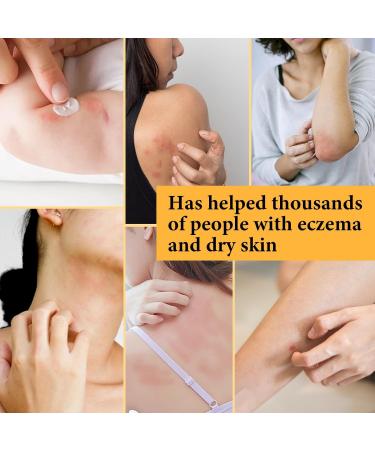 Max Strength Treat Natural Organic Manuka Honey Cream Ointment Soothing Relief for Dry Heat Rash Hidradenitis Itchy Eczema Psoriasis Leg Belly Armpit Foot Hand Irritable Skin For All Ages 4 Fl Oz (Pack of 1) - Buy Online on GoSupps.com