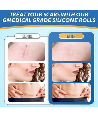 LONNIELONLI Silicone Scar Sheets - 2 Pack 1.6x60 Roll - Reusable Professional Scar Removal Tape for C-Section, Surgery, Burn, Keloid, Acne - Buy Online on GoSupps.com