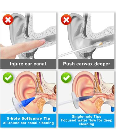 Ear Wax Removal Kit Easy to Operate Manual Ear Irrigation Flushing System for Adults & Kids Safe and Effective Ear Cleaner Tool for Wax Build Up Flushing - Buy Online on GoSupps.com