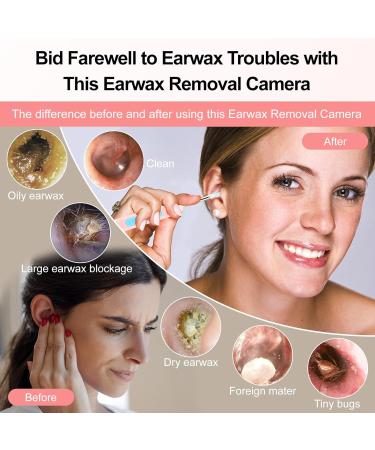 Ear Wax Removal Ear Cleaner with 1080P HD Camera with 6 LED Lights/IP67 Waterproof Lens/8 Traditional Tools Ear Wax Removal Kit Rechargeable Ear Cleaning kit for iOS Android Tablet (Pink05) - Buy Online on GoSupps.com