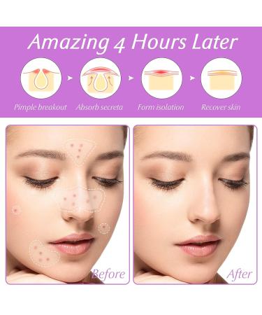 Acne Pimple Patches for Large Zit Breakouts - 102 Hydrocolloid Bandages with Tea Tree & Salicylic Acid - Buy Online on GoSupps.com