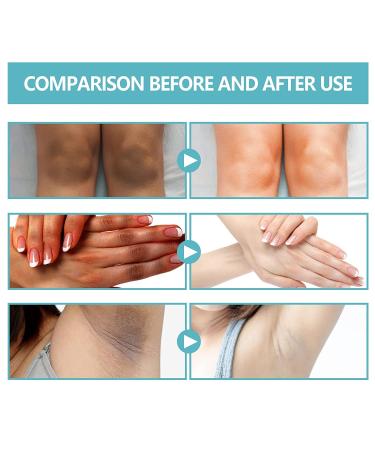 Virularty Dark Spot Correcting Cream + Nigrifree Acanthosis Nigricans Therapy - 50g x 2pcs - Buy Online on GoSupps.com